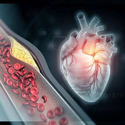 Abbildung eines verkalkten Blutgefäßes, daneben ein ist ein Herz abgebildet
